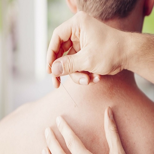 ACUPUNTURA (1/2 HORA)