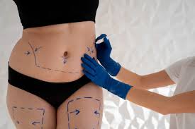 SESION MESOTERAPIA CORPORAL