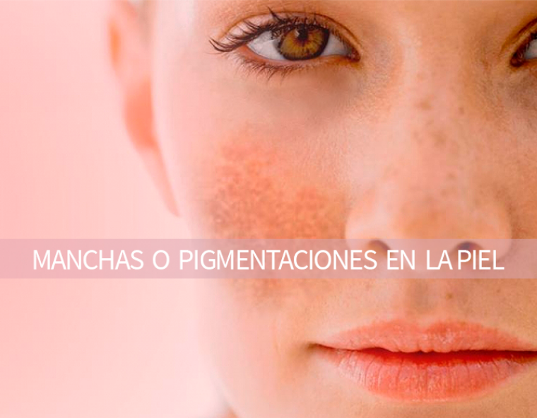 5 SESIONES TRATAMIENTO MANCHAS