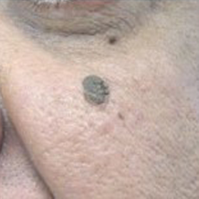 Queratosis